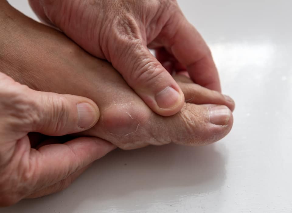 Hallux rigidus surgery Perth | Dr Gerard Hardisty | The Foot & Ankle Centre
