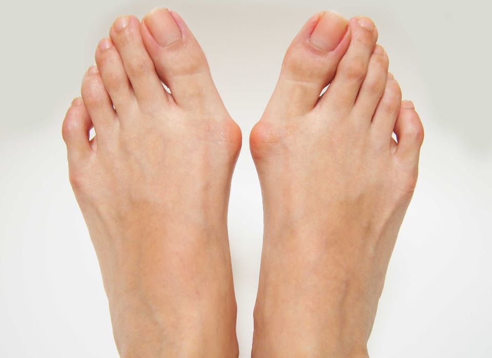 Bunion surgery Perth at The Foot and Ankle Centre