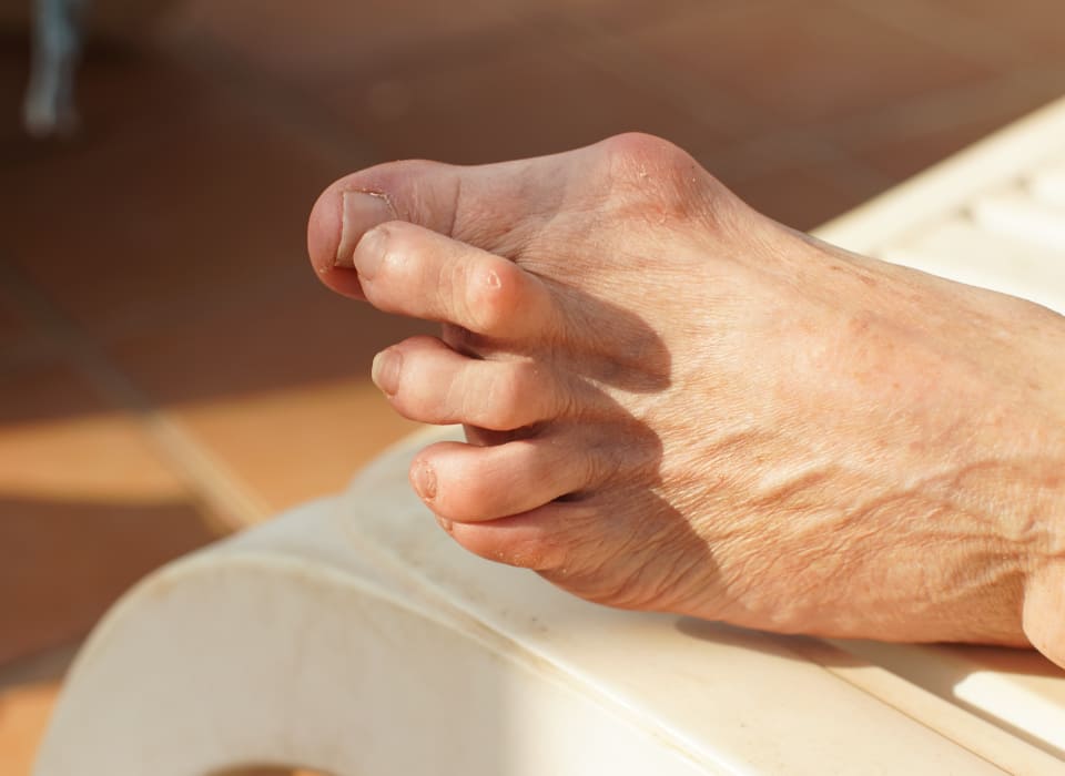 Bunion surgery Perth at The Foot and Ankle Centre